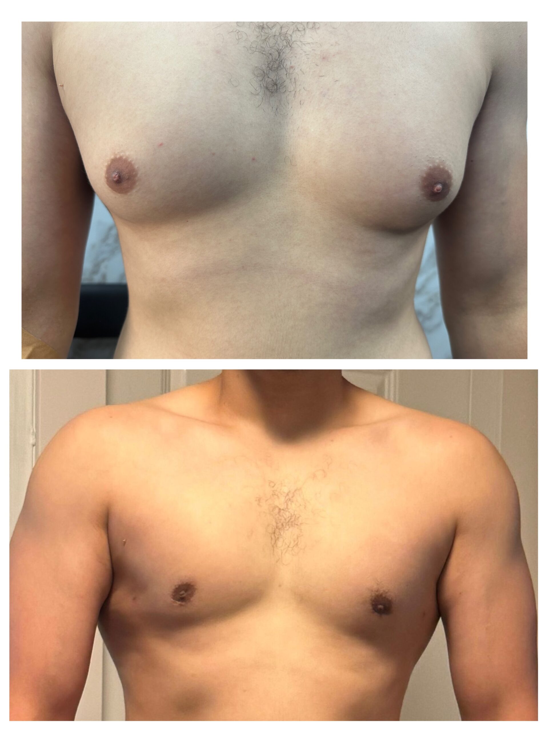 Gynecomastia surgery preview