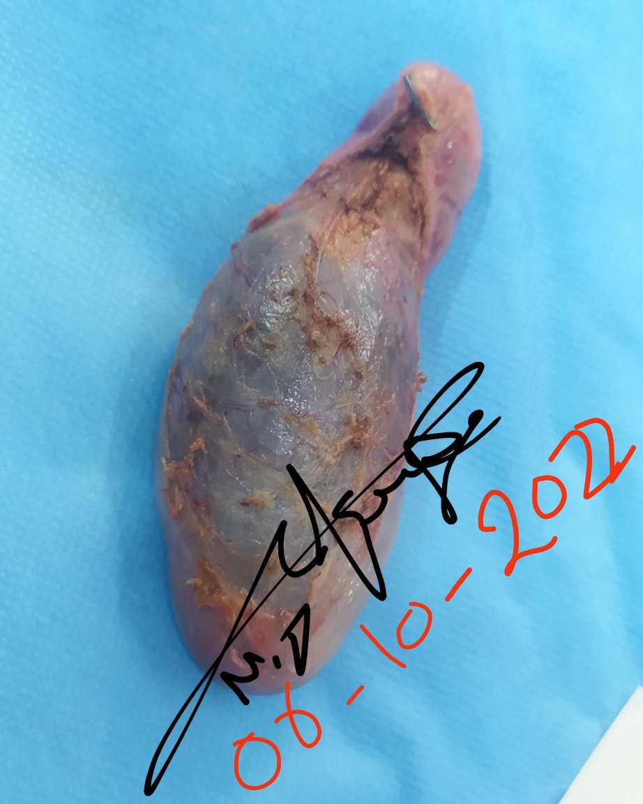 رسم توضيحي للمرارة