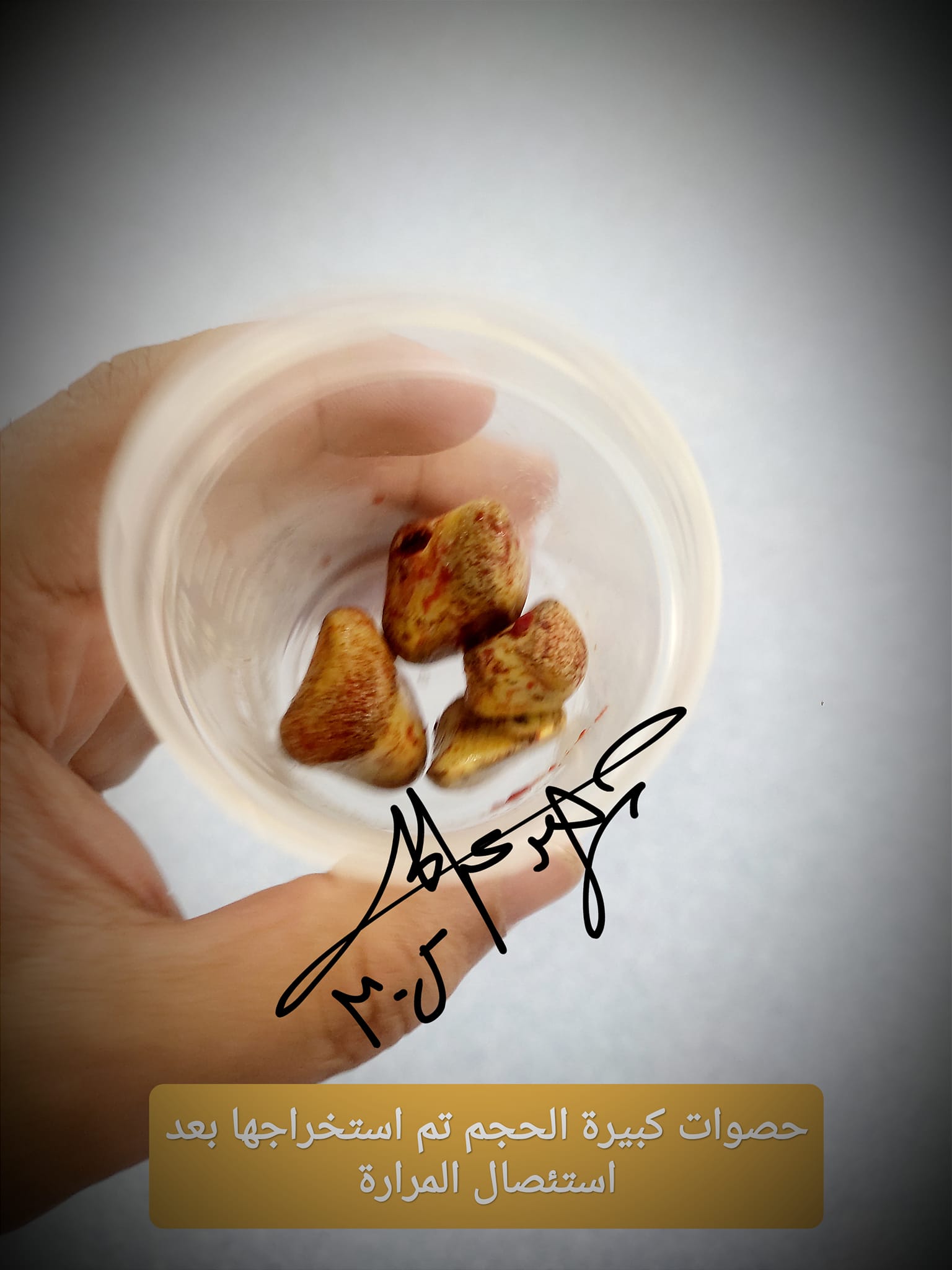 Gallbladder laparoscopic surgery preview